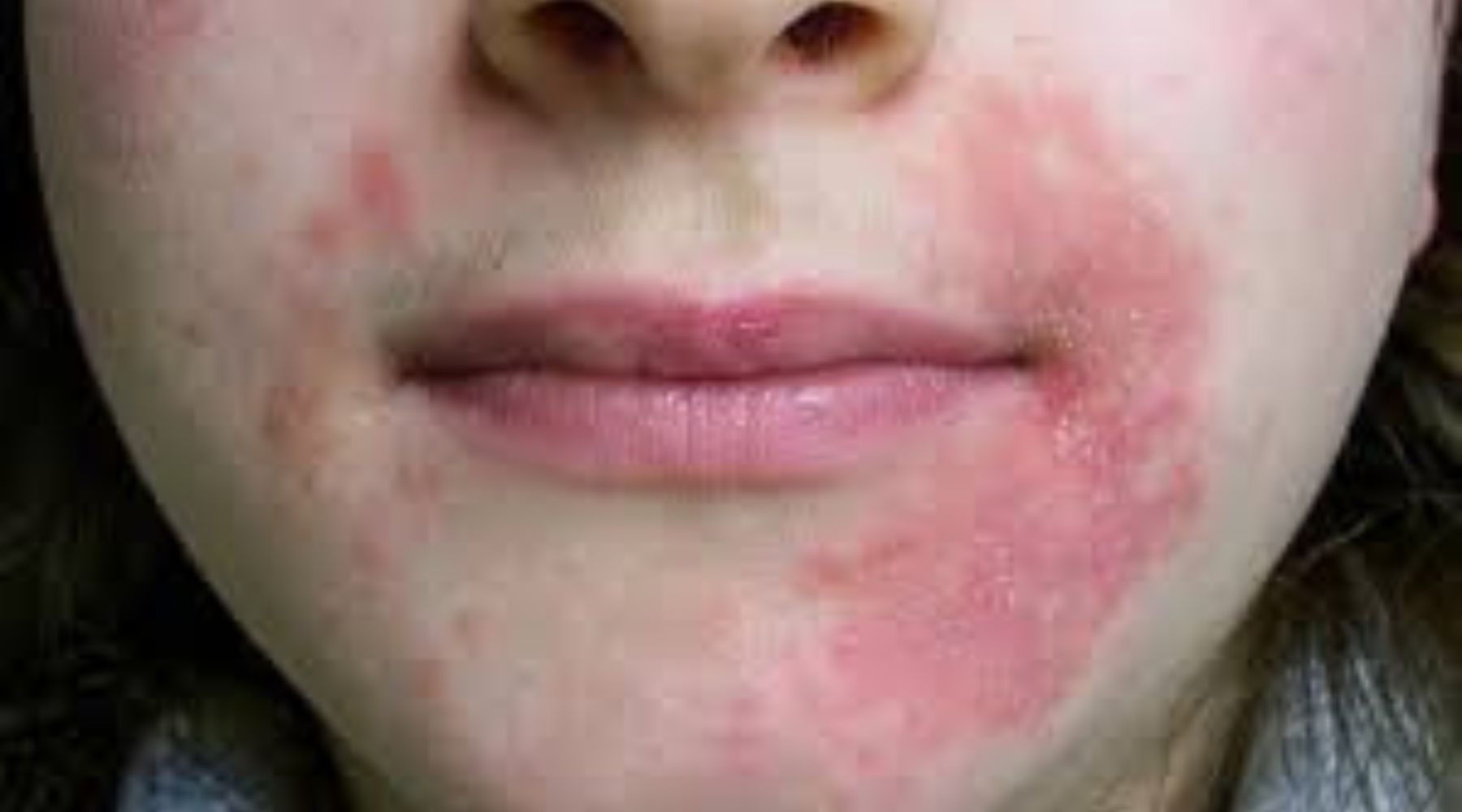 Understanding POD Perioral Dermatitis: Causes, Symptoms, and Natural T   Henua - Organic skincare