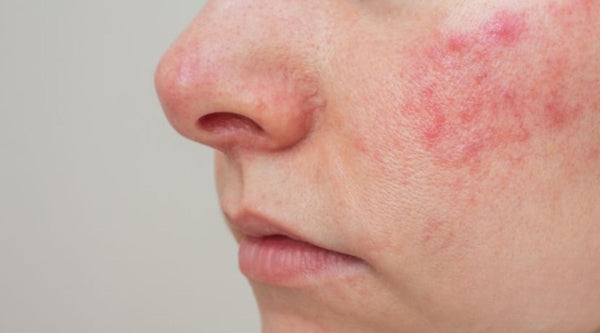 Understanding Rosacea: Symptoms, Causes, and Natural Skincare Solutions